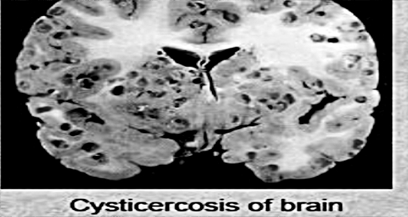 neurocysticercosis